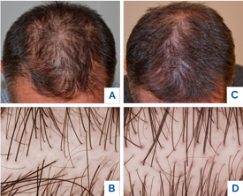 Tricopat androgenic alopecia solution banner