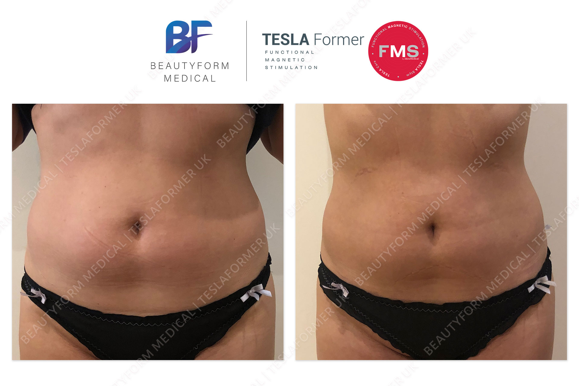 Tesla Former Abs before and after Muscle Stimulation