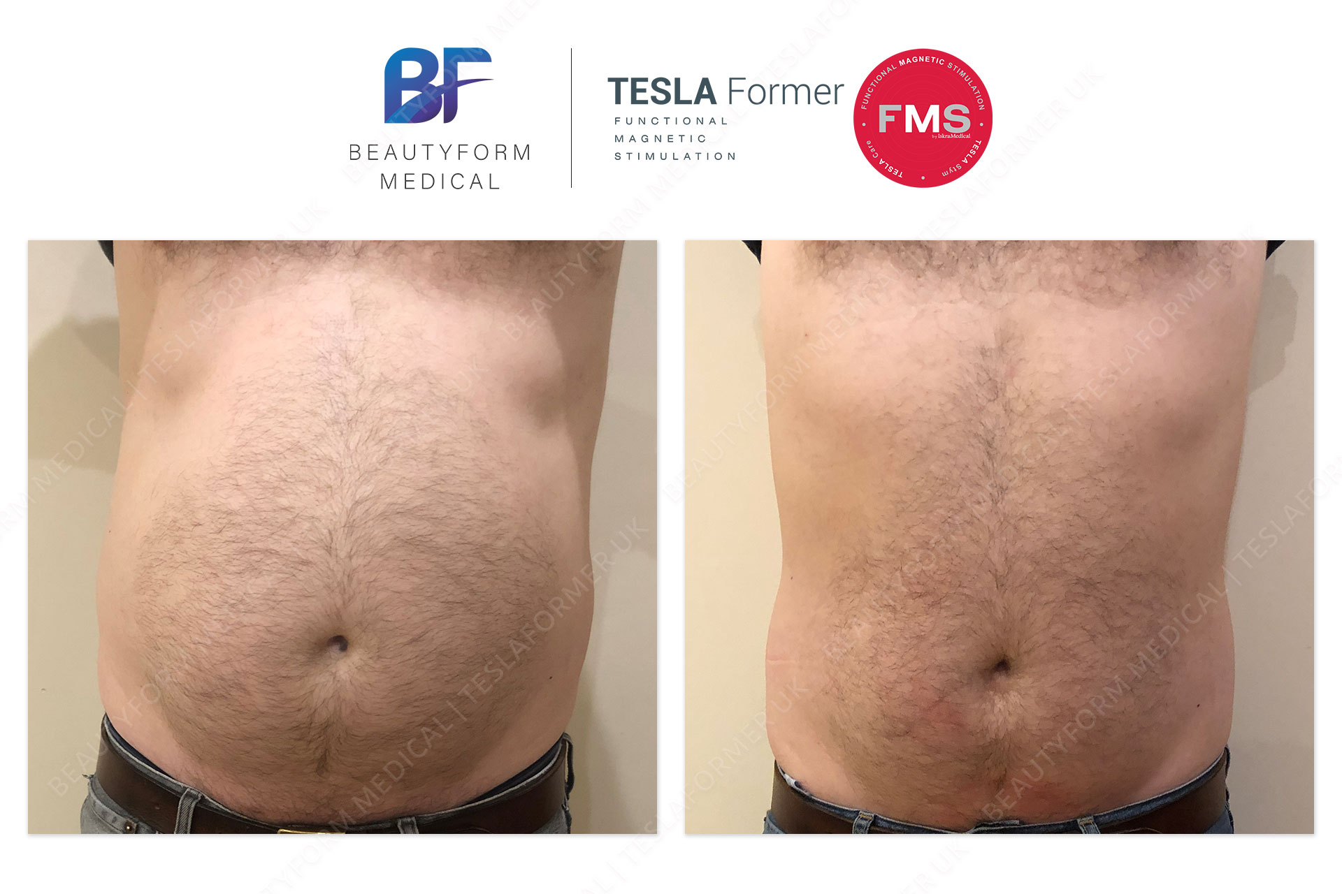 Tesla Former Abs muscle stimulation before and after